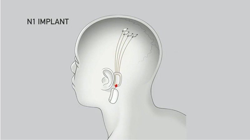 Имплантат Bci Neuralink